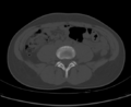 Aneurysmal bone cyst of ischium (Radiopaedia 25957-26094 Axial bone window 5).png