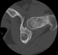 Aneurysmal bone cyst of ischium (Radiopaedia 25957-26094 B 21).png