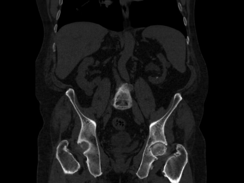 File:Ankylosing spondylitis (Radiopaedia 44609-48357 Coronal bone window 41).jpg