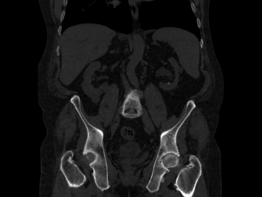 Ankylosing spondylitis (Radiopaedia 44609-48357 Coronal bone window 41).jpg