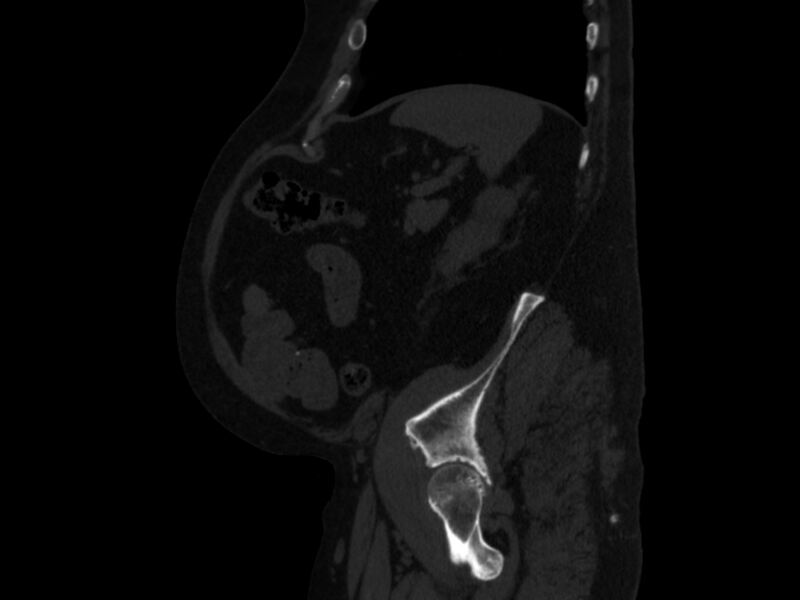 File:Ankylosing spondylitis (Radiopaedia 44609-48357 Sagittal bone window 91).jpg