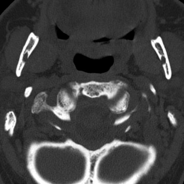 File:Anterior cervical postdiscectomy arthrodesis (Radiopaedia 32678-33646 Axial bone window 14).jpg