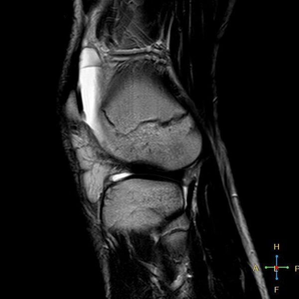 File:Anterior cruciate ligament tear - complete (Radiopaedia 24907-25170 Sagittal T2 3).jpg