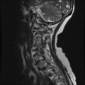 Anterior spinal artery syndrome (Radiopaedia 46335-50750 A 8).png