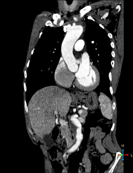 File:Aortic aneurysm and penetrating ulcer (Radiopaedia 23590-23704 B 1).jpg