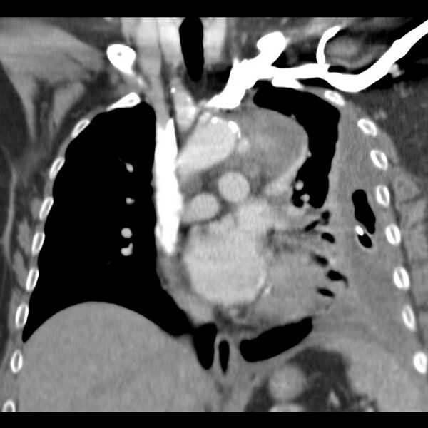 File:Aortic arch false aneurysm (Radiopaedia 14667-14588 B 5).jpg
