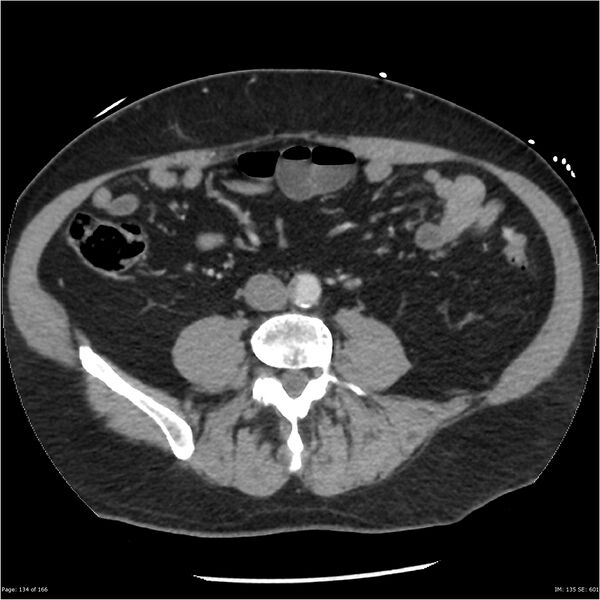 File:Aortic dissection- Stanford A (Radiopaedia 37759-39664 A 125).jpg