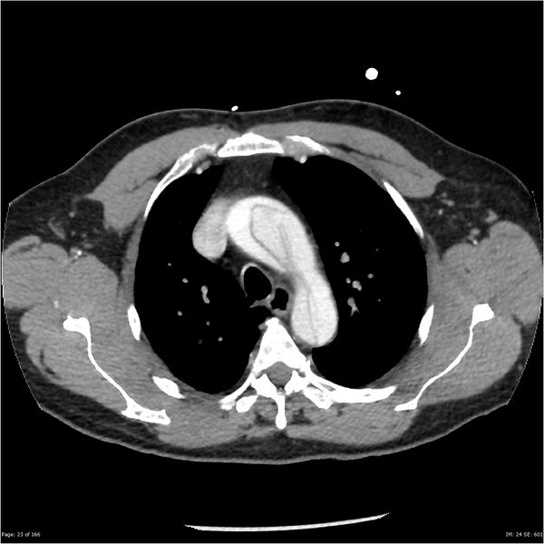 File:Aortic dissection- Stanford A (Radiopaedia 37759-39664 A 14).jpg