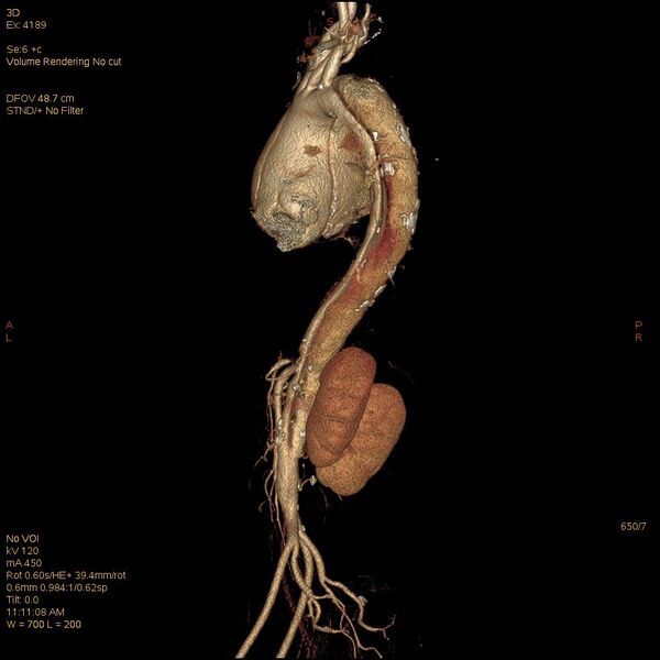 File:Aortic dissection (Radiopaedia 25350-25604 E 7).jpg