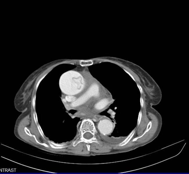File:Aortic dissection - Stanford type A (Radiopaedia 20760-20675 C 2).jpg