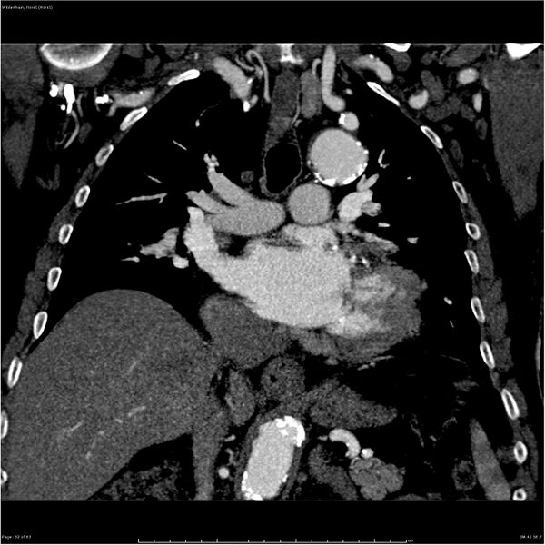 File:Aortic dissection - Stanford type A (Radiopaedia 26183-26315 A 32).jpg