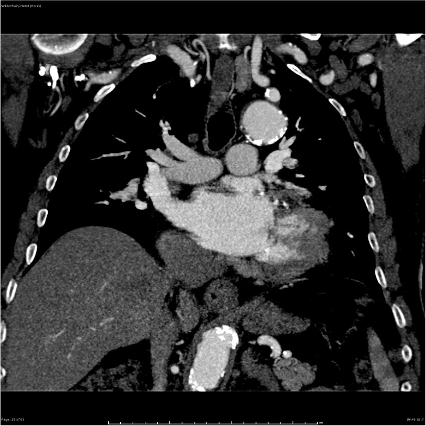 Aortic dissection - Stanford type A (Radiopaedia 26183-26315 A 32).jpg
