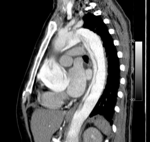 File:Aortic dissection - Stanford type A (Radiopaedia 29247-29659 C 23).jpg