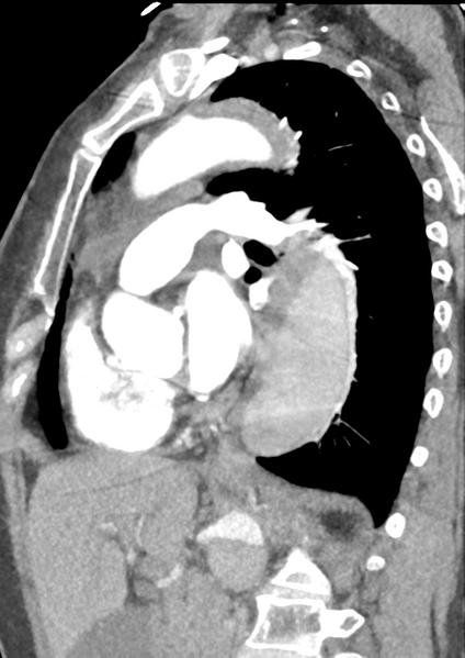 File:Aortic dissection - Stanford type B (Radiopaedia 50171-55512 C 23).png