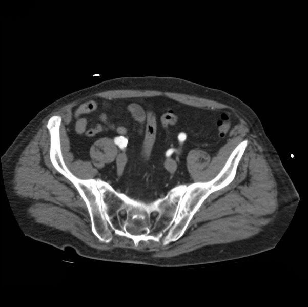 File:Aortic dissection with rupture into pericardium (Radiopaedia 12384-12647 A 78).jpg