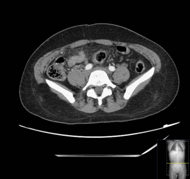 File:Appendicitis (CT angiogram) (Radiopaedia 154713-127660 Axial 29).jpg