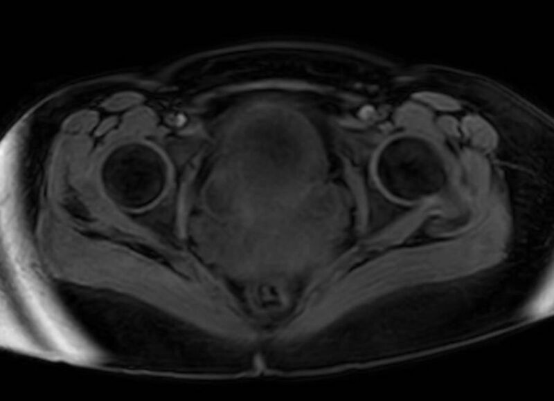 File:Appendicitis in gravida (MRI) (Radiopaedia 89433-106395 Axial DIXON 141).jpg