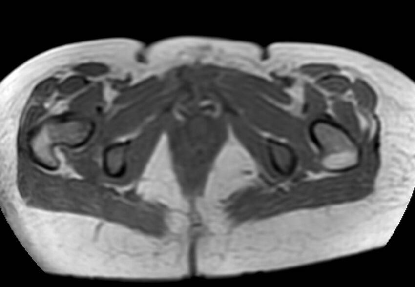 Appendicitis in gravida (MRI) (Radiopaedia 89433-106395 Axial T1 in-phase 71).jpg