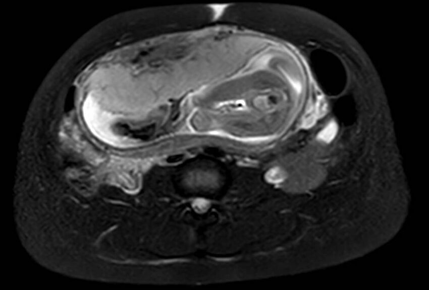 Appendicitis in gravida (MRI) (Radiopaedia 89433-106395 Axial T2 SPAIR 43).jpg