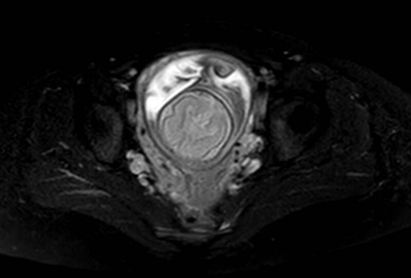 File:Appendicitis in gravida (MRI) (Radiopaedia 89433-106395 Axial T2 SPAIR 67).jpg