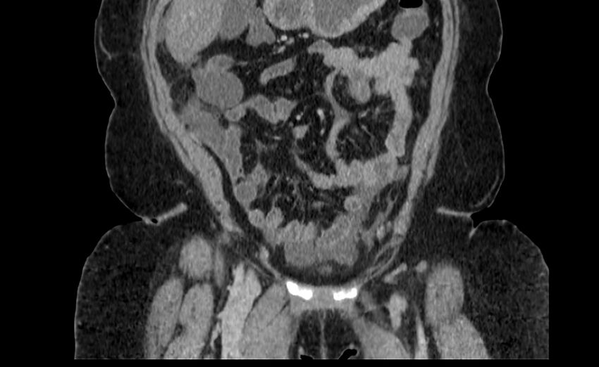 Appendix mucocele (Radiopaedia 41222-44033 B 15).jpg