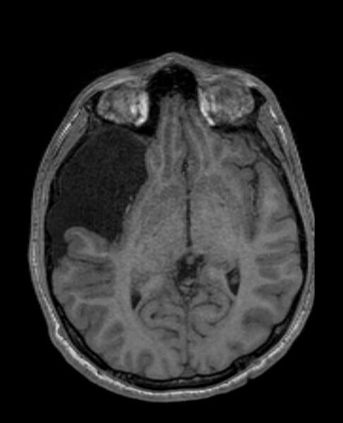 File:Arachnoid cyst- extremely large (Radiopaedia 68741-78451 Axial T1 36).jpg