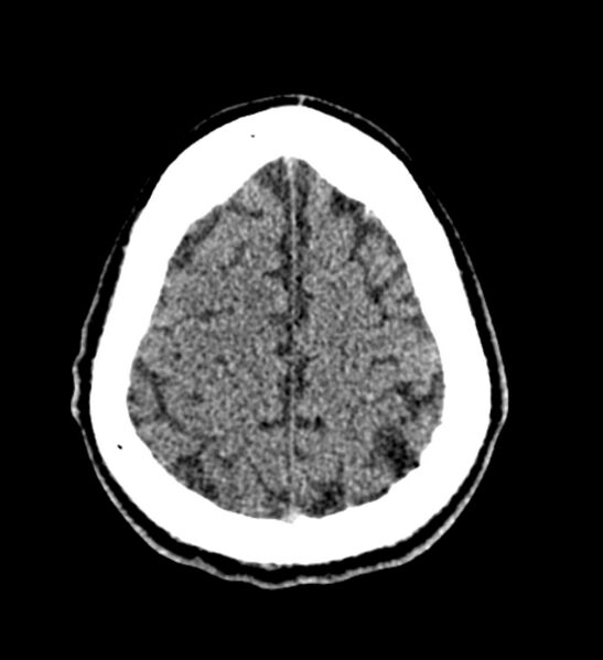 File:Arachnoid cyst of the ambient cistern (Radiopaedia 81301-94986 Axial non-contrast 59).jpg