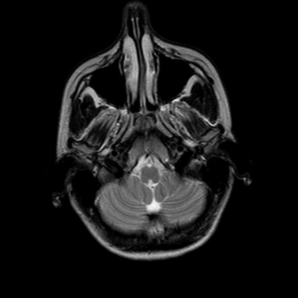 File:Arrested pneumatization of the sphenoid (Radiopaedia 10700-11173 Axial T2 3).jpg