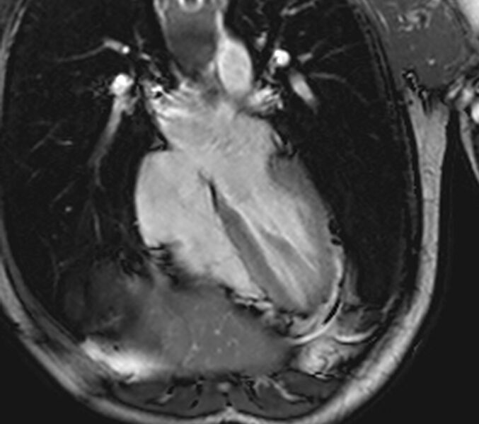 File:Arrhythmogenic right ventricular cardiomyopathy (Radiopaedia 39806-42237 D 88).jpg