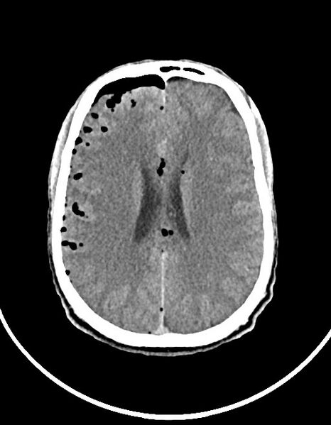 File:Arrow injury to the brain (Radiopaedia 72101-82607 Axial 59).jpg