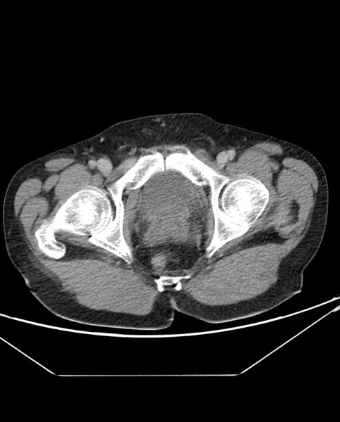 File:Arterial occlusive mesenteric ischemia (Radiopaedia 84641-100054 A 116).jpg