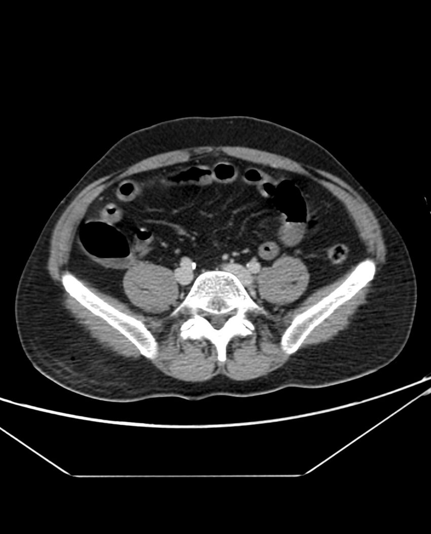 Arterial occlusive mesenteric ischemia (Radiopaedia 84641-100054 A 83).jpg