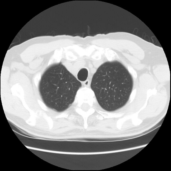 File:Asbestos-related pleural plaques (Radiopaedia 39069-41255 Axial lung window 11).jpg