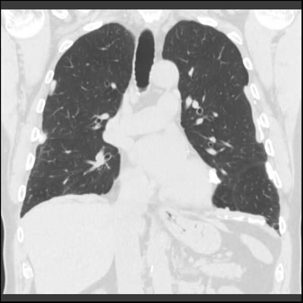 File:Asbestos-related pleural plaques (Radiopaedia 39069-41255 Coronal lung window 48).jpg