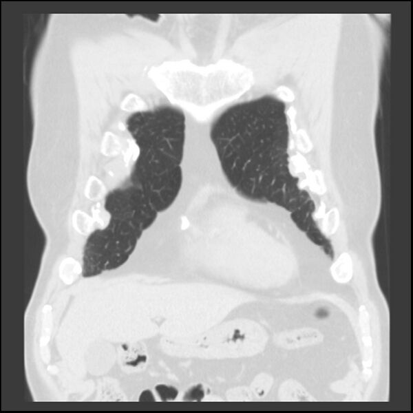 File:Asbestos-related pleural plaques (Radiopaedia 39069-41255 Coronal lung window 74).jpg
