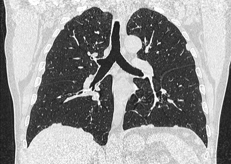 File:Asbestos pleural placques (Radiopaedia 57905-64872 Coronal lung window 163).jpg