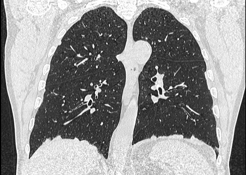 File:Asbestos pleural placques (Radiopaedia 57905-64872 Coronal lung window 180).jpg