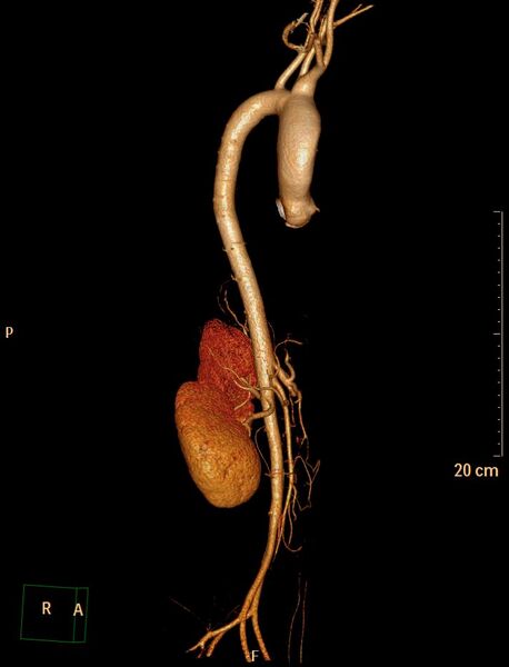 File:Ascending aortic pseudoaneurysm (Radiopaedia 28638-28910 D 7).jpg