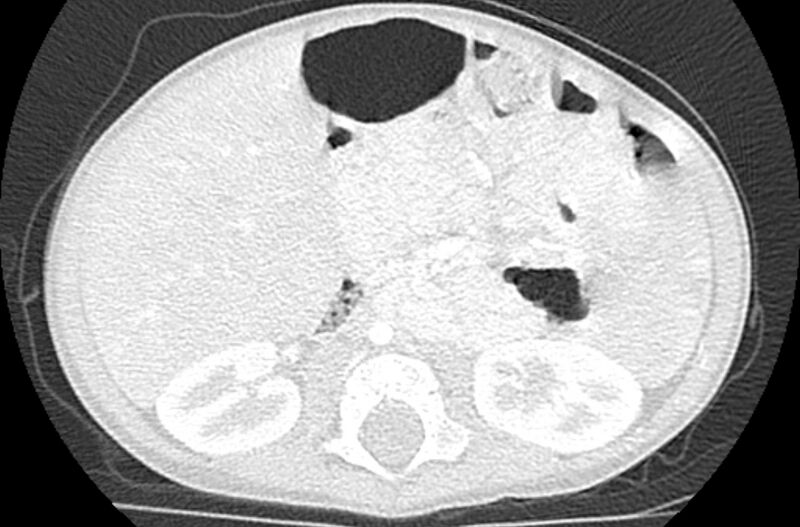 File:Asplenia syndrome (Radiopaedia 73083-83792 Axial lung window 95).jpg