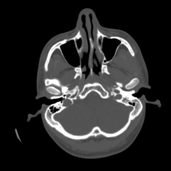 File:Asymptomatic occipital spur (Radiopaedia 87753-104201 Axial bone window 22).jpg