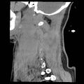 Atlanto-occipital dislocation (Radiopaedia 44648-48412 A 5).jpg