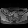 Atypical deep infiltrating endometriosis (Radiopaedia 44470-48125 Axial T1 fat sat 5).jpg