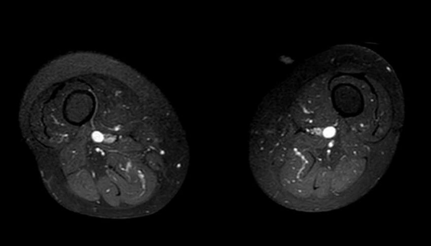 Atypical lipomatous tumor - thigh (Radiopaedia 68975-78734 Axial T1 C+ fat sat 34).jpg