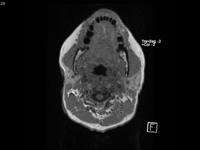 Atypical meningioma - intraosseous (Radiopaedia 64915-74572 Axial T1 26).jpg