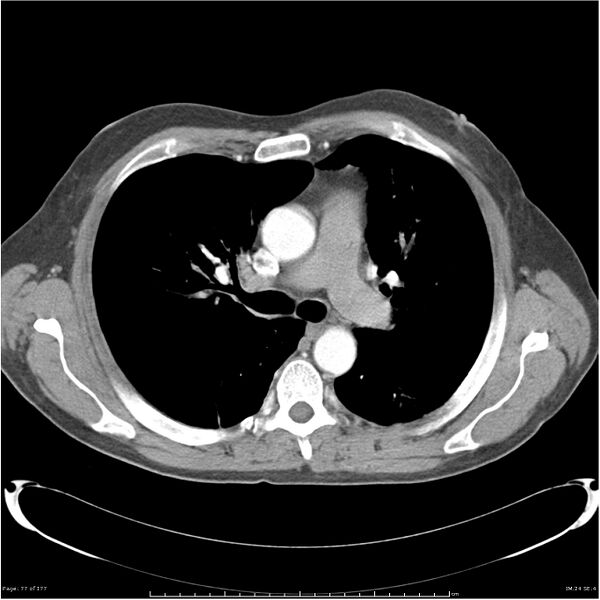 File:Atypical pneumonia - Q fever (Radiopaedia 21993-21989 C+ arterial phase 19).jpg