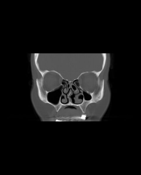 File:Automastoidectomy with labyrinthine fistula (Radiopaedia 84143-99411 Coronal non-contrast 28).jpg