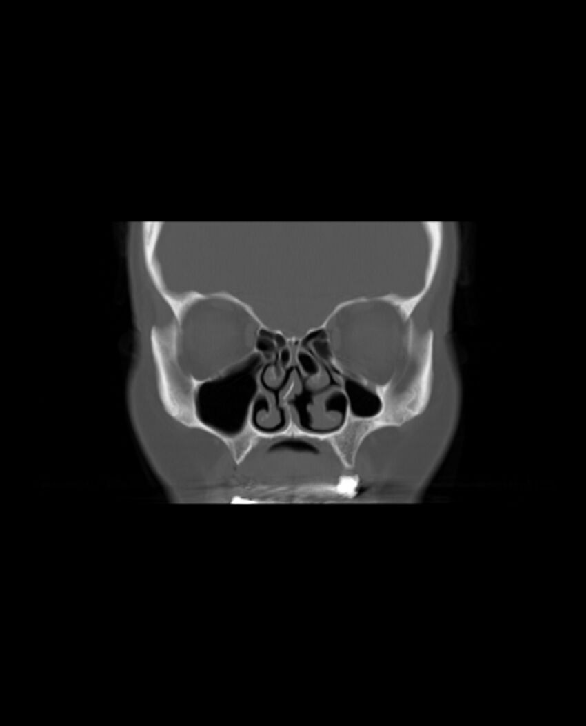 Automastoidectomy with labyrinthine fistula (Radiopaedia 84143-99411 Coronal non-contrast 28).jpg