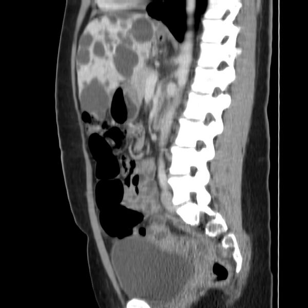 File:Autosomal dominant polycystic kidney disease (Radiopaedia 23061-23093 F 31).jpg