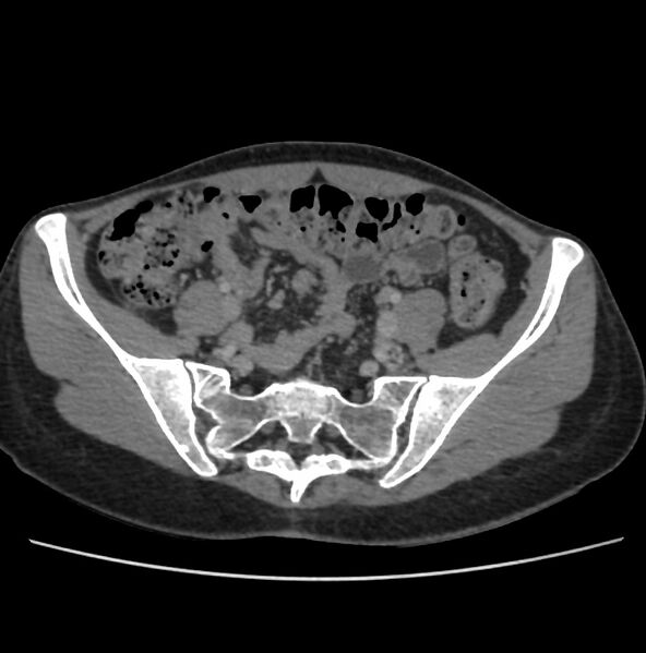 File:Autosomal dominant polycystic kidney disease - early onset (Radiopaedia 40734-43387 A 65).jpg