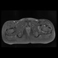 Avascular necrosis of the hip (Radiopaedia 29563-30067 Axial T1 C+ fat sat 13).jpg
